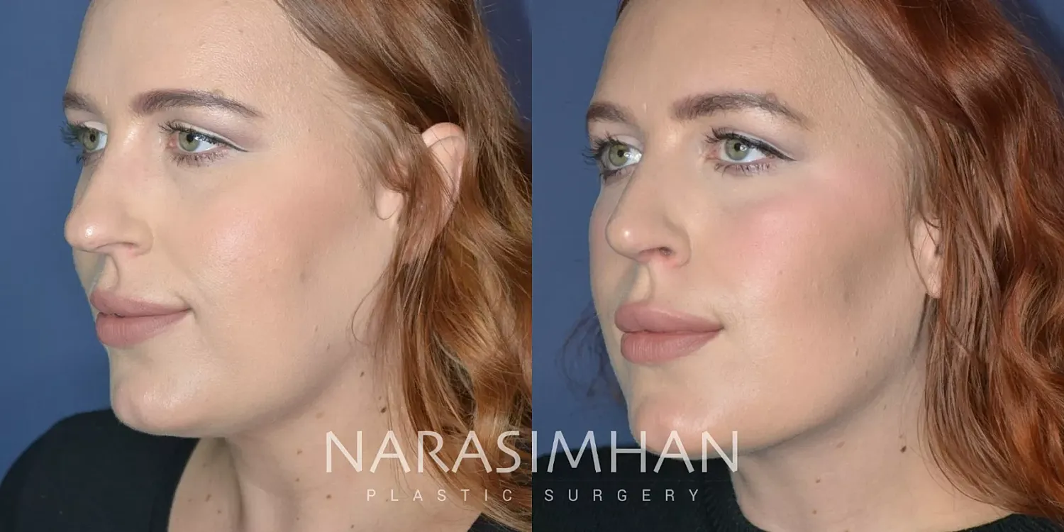 Rhinoplasty Before & After