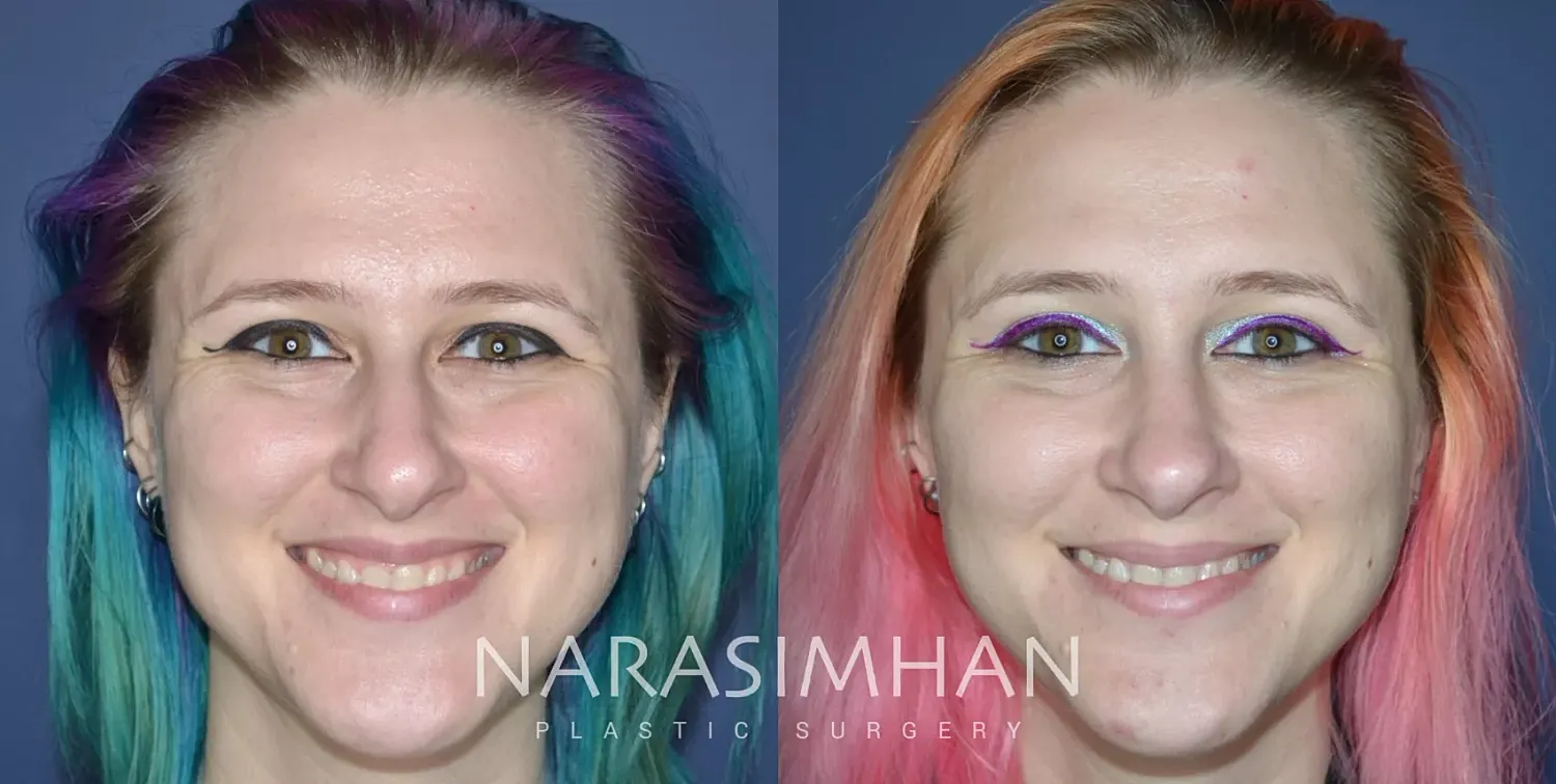 Rhinoplasty Before & After
