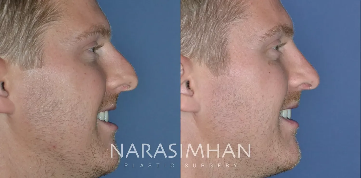 Rhinoplasty Before & After