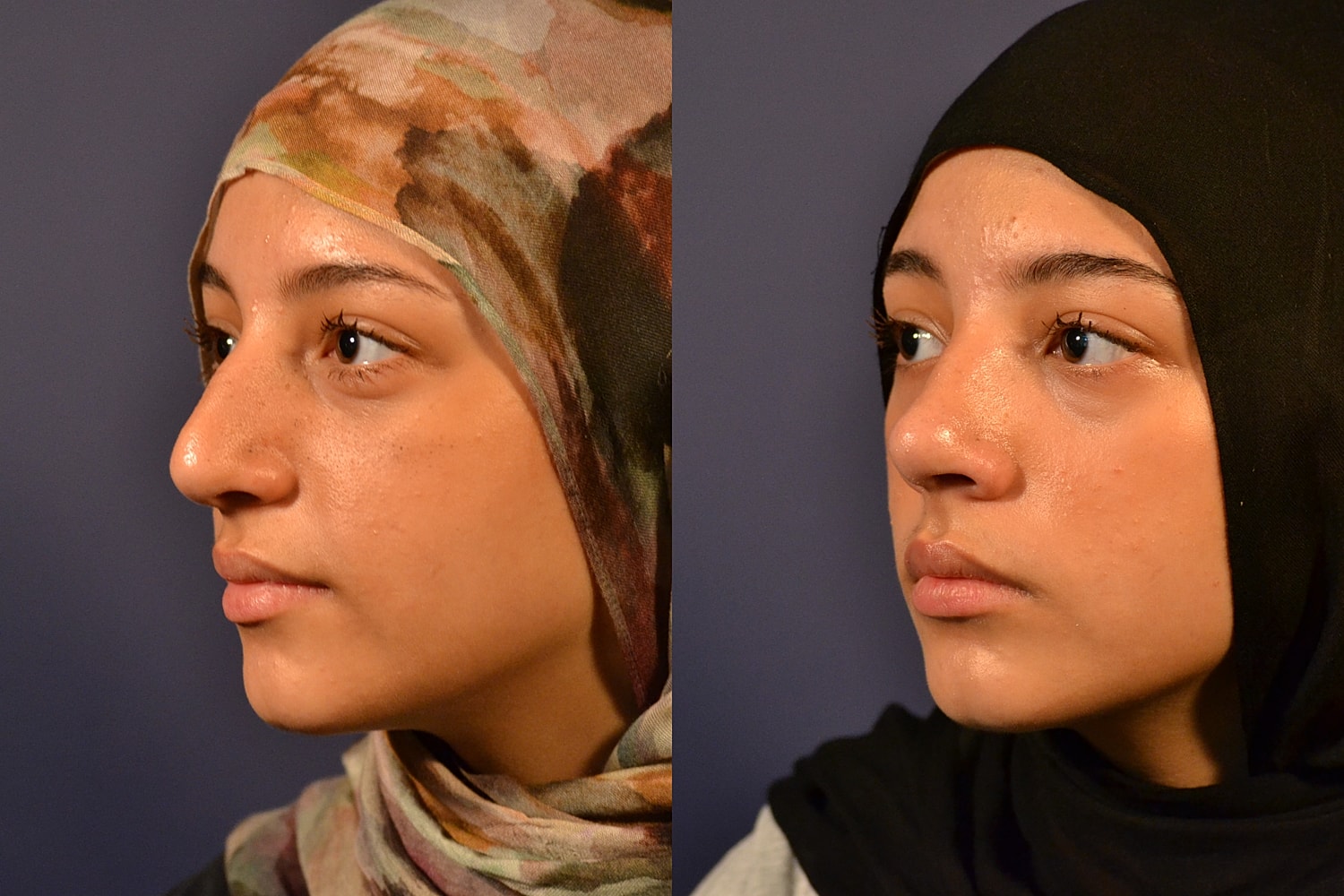 Rhinoplasty Before & After