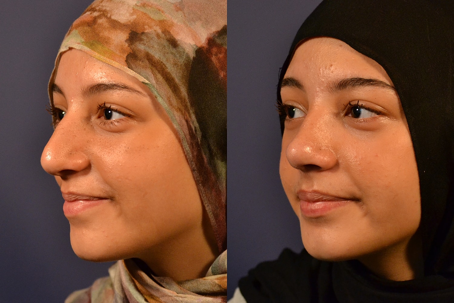 Rhinoplasty Before & After