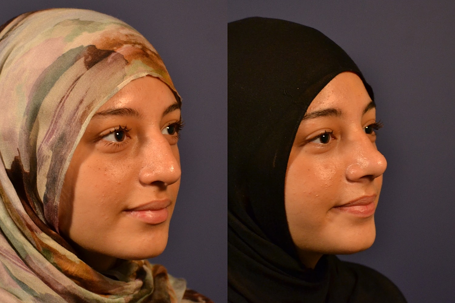 Rhinoplasty Before & After