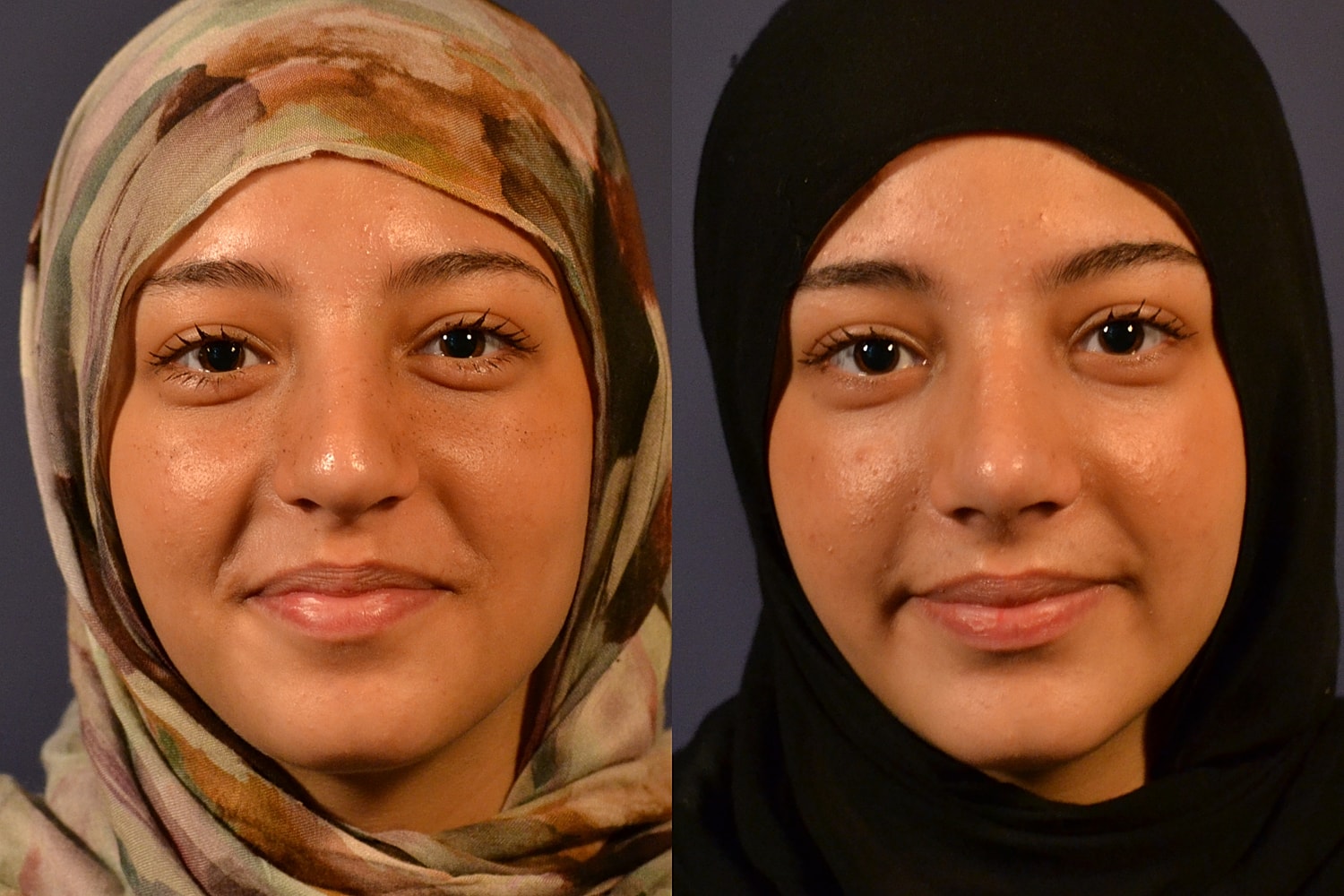 Rhinoplasty Before & After