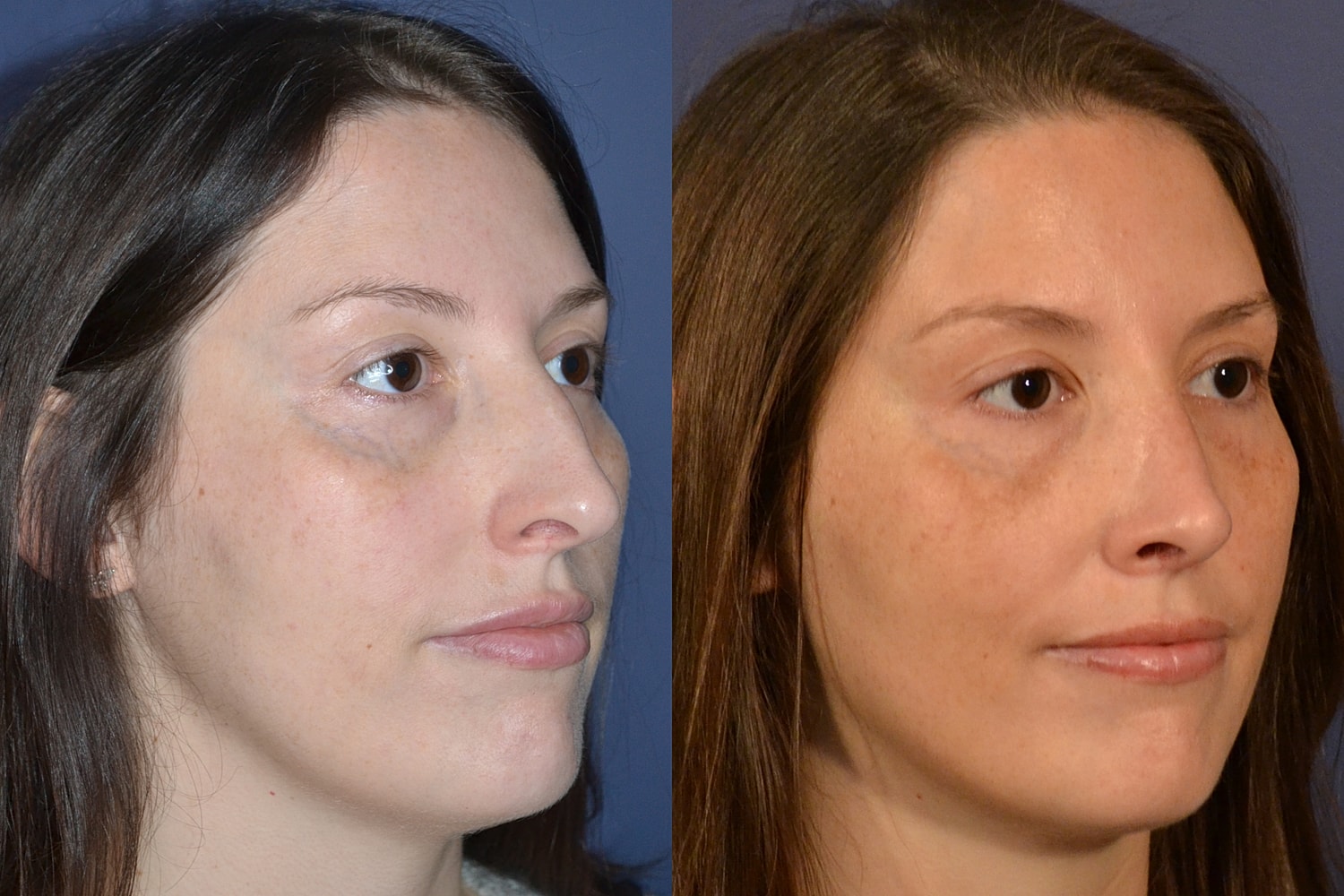 Before and after facial treatment comparison image.