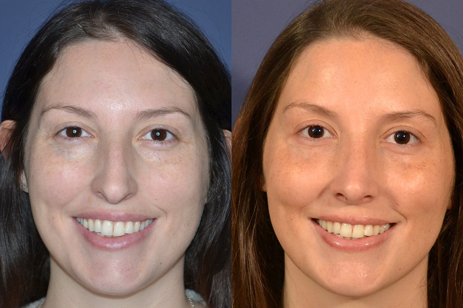 Before and after facial appearance comparison.
