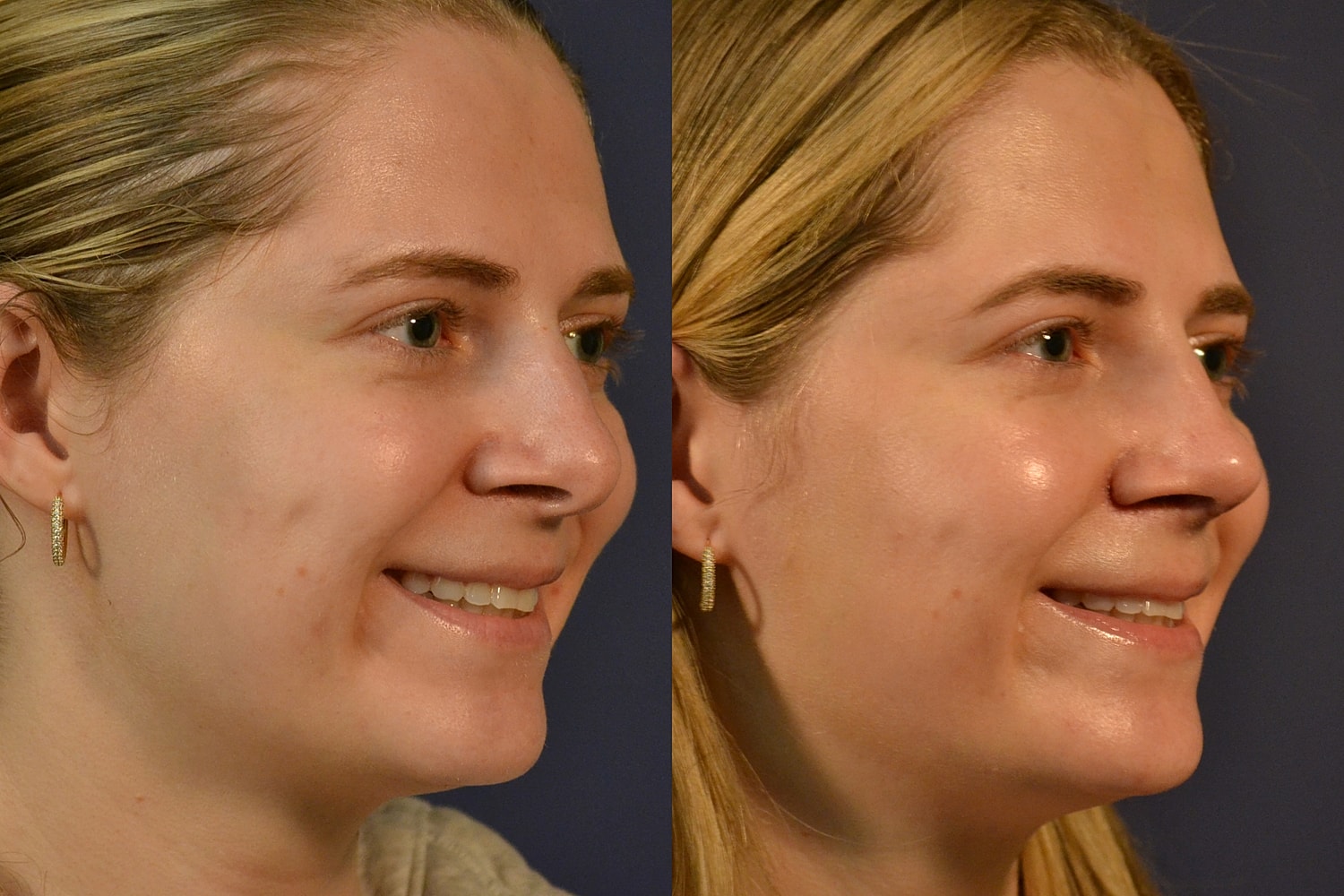 Rhinoplasty Before & After