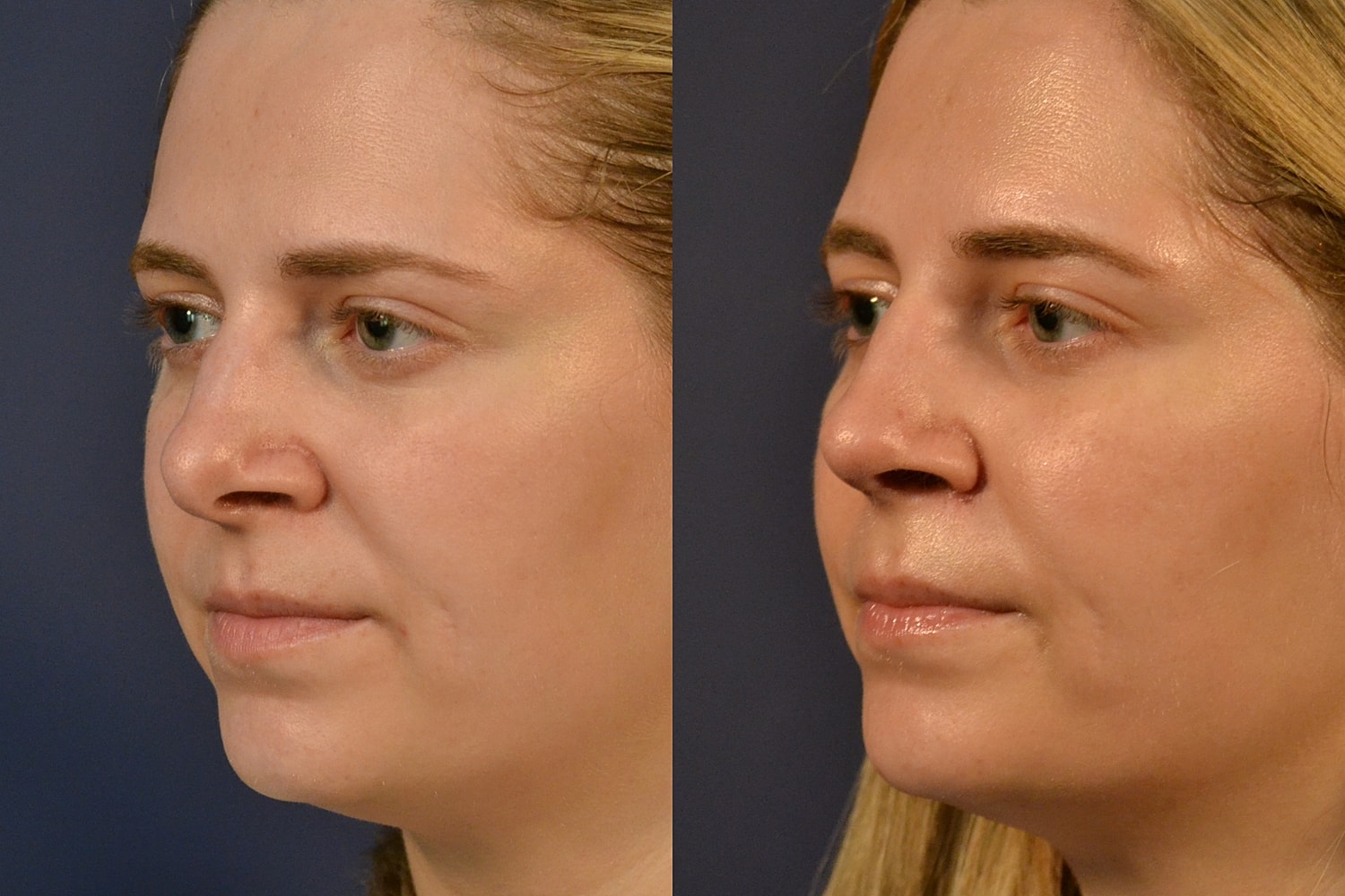 Rhinoplasty Before & After