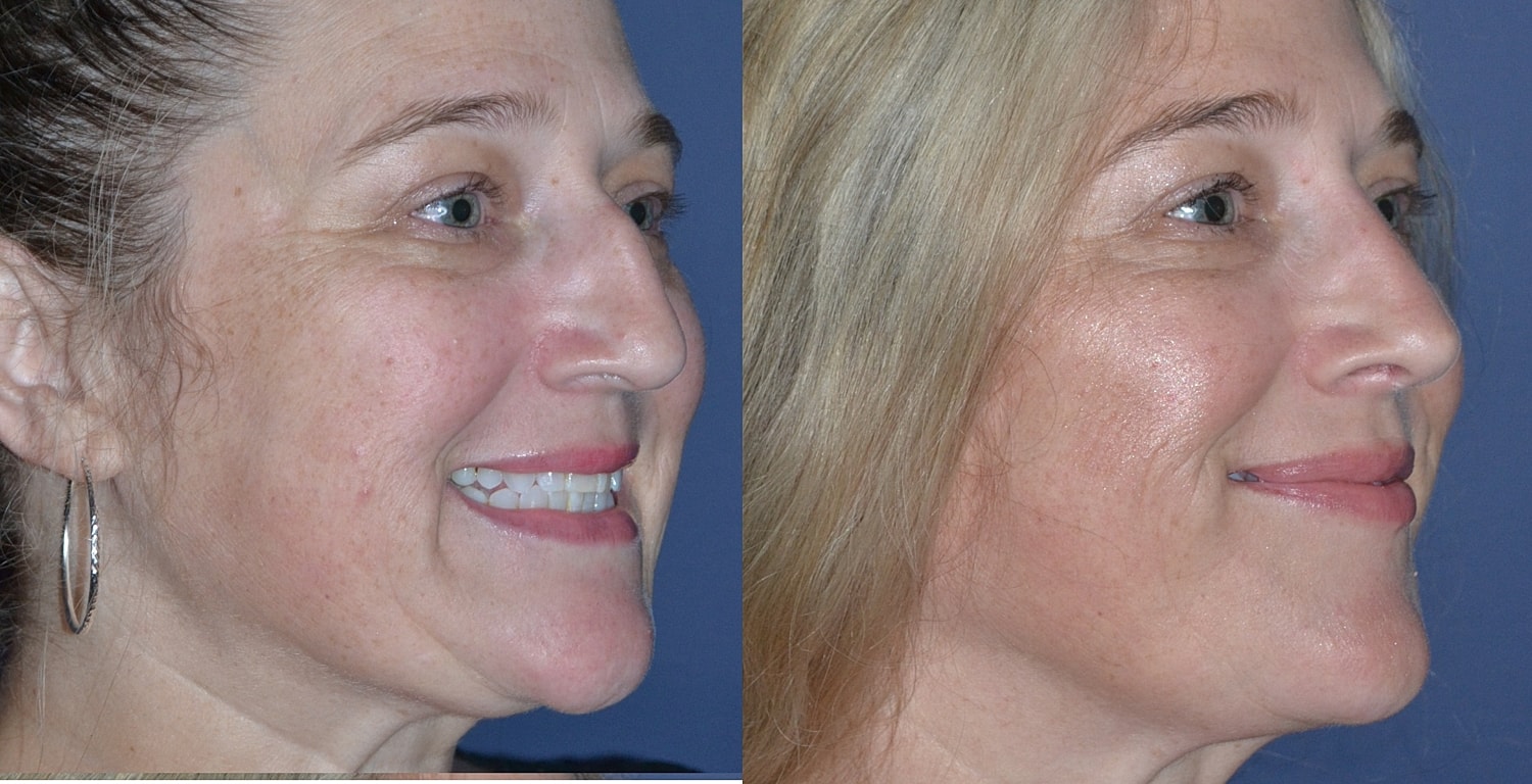 Rhinoplasty Before & After