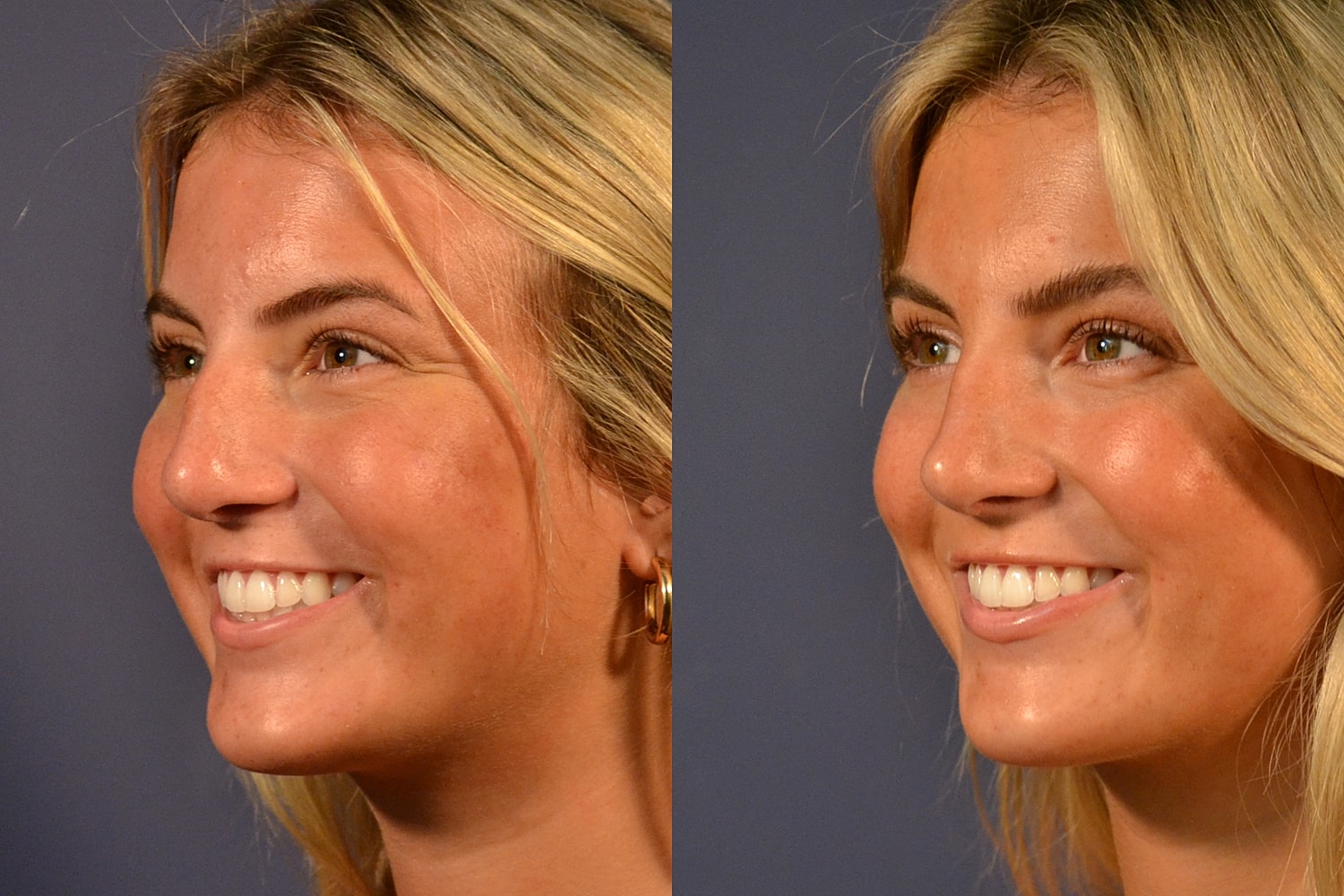 Rhinoplasty Before & After