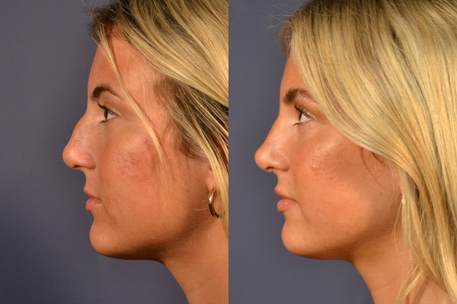 Rhinoplasty Before & After
