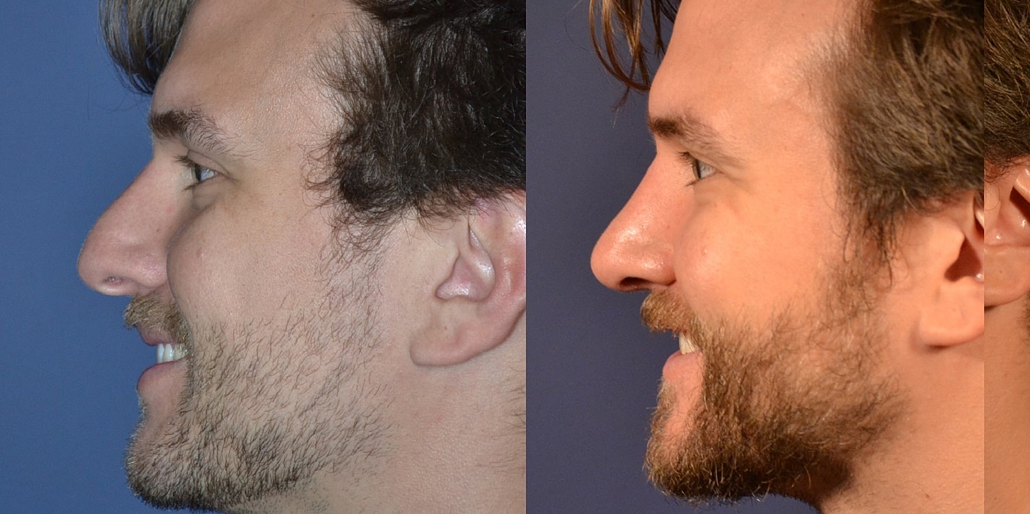 Before and after profile comparison of a man
