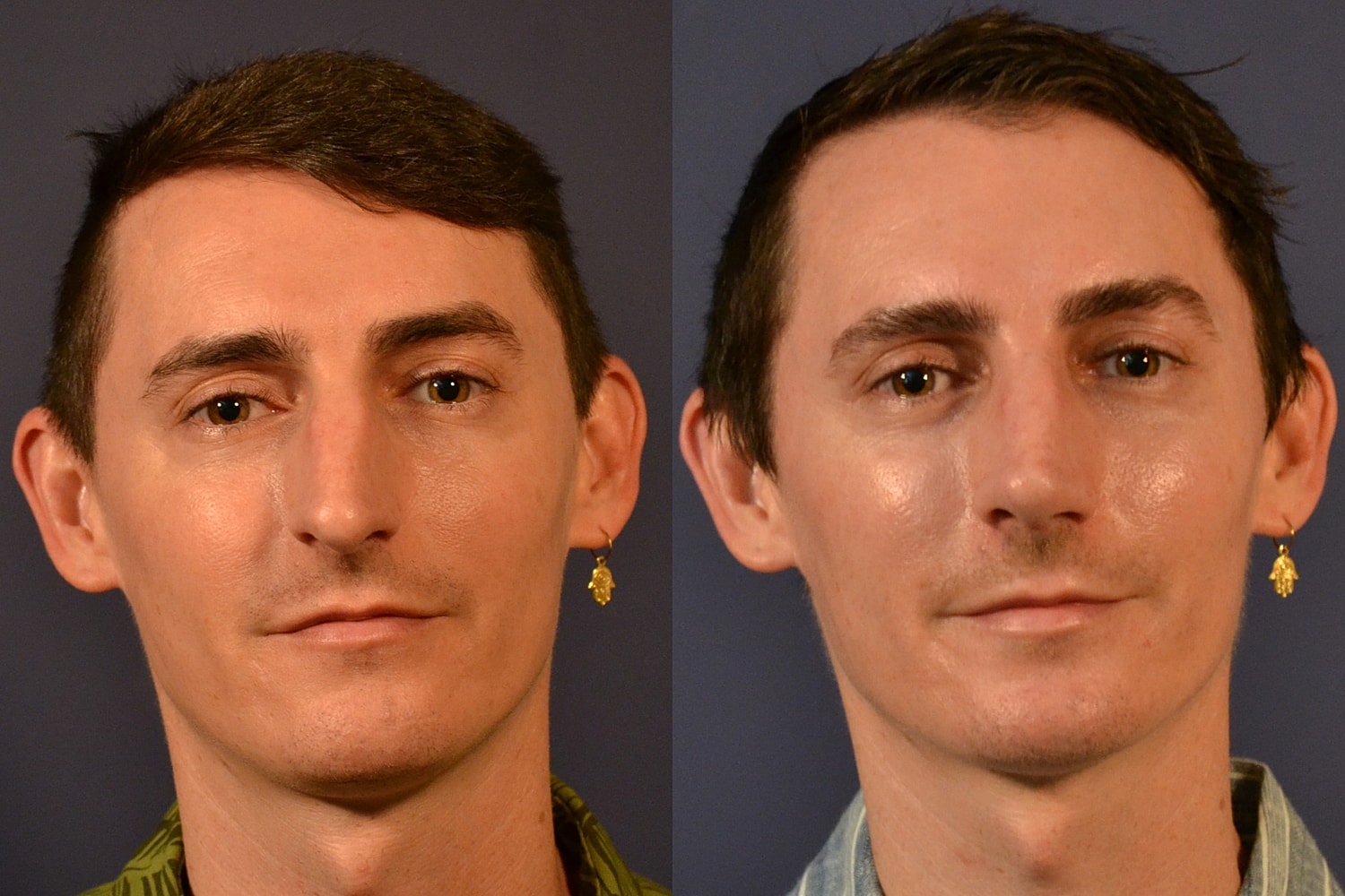 Rhinoplasty Before & After