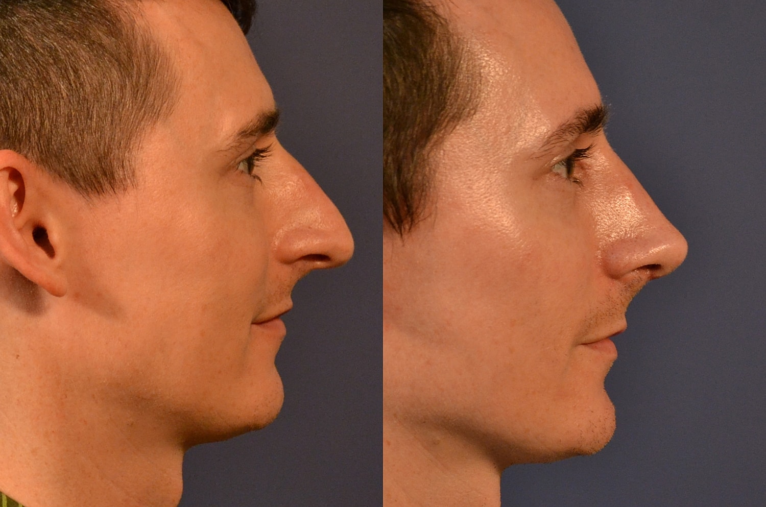 Rhinoplasty Before & After