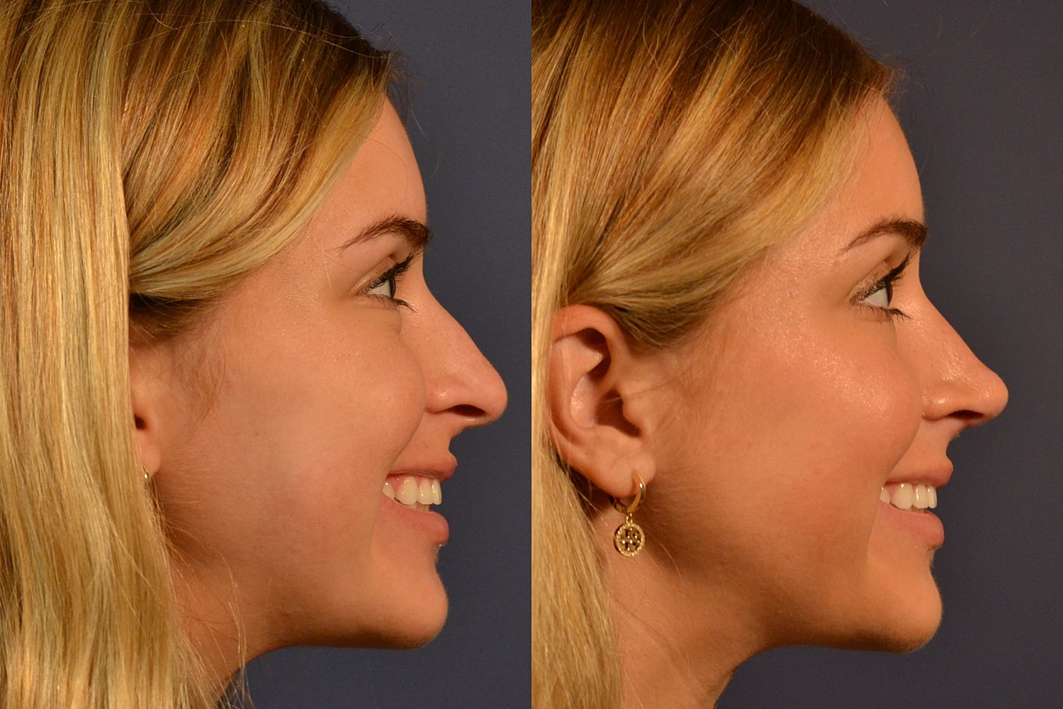 Before and after side profile comparison of woman.