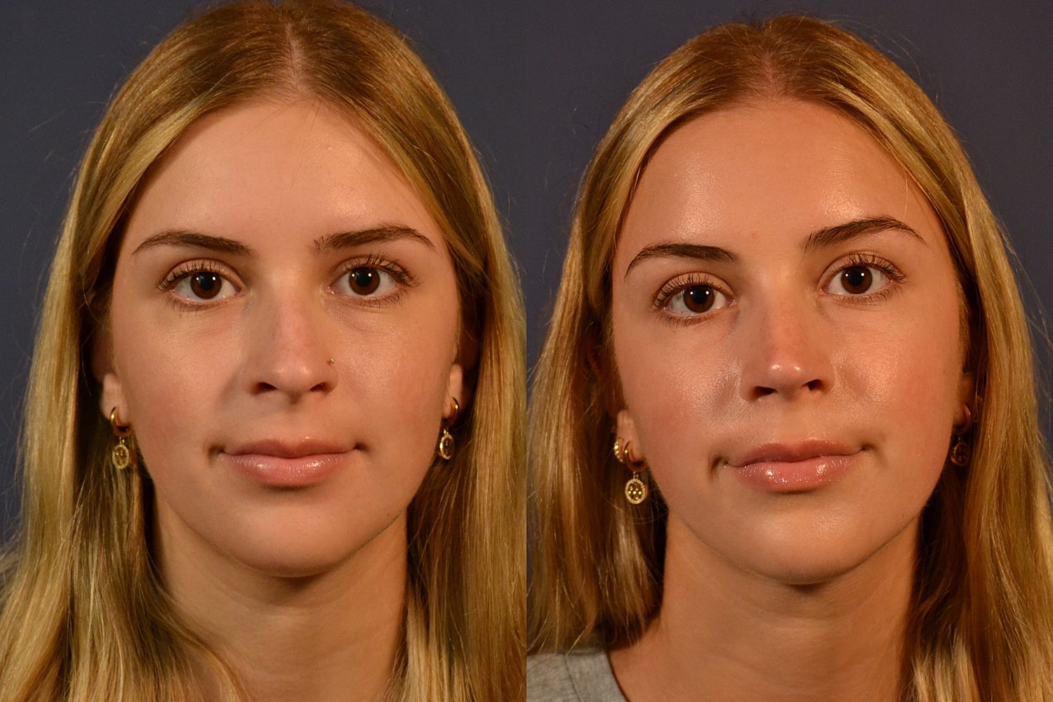 Rhinoplasty Before & After