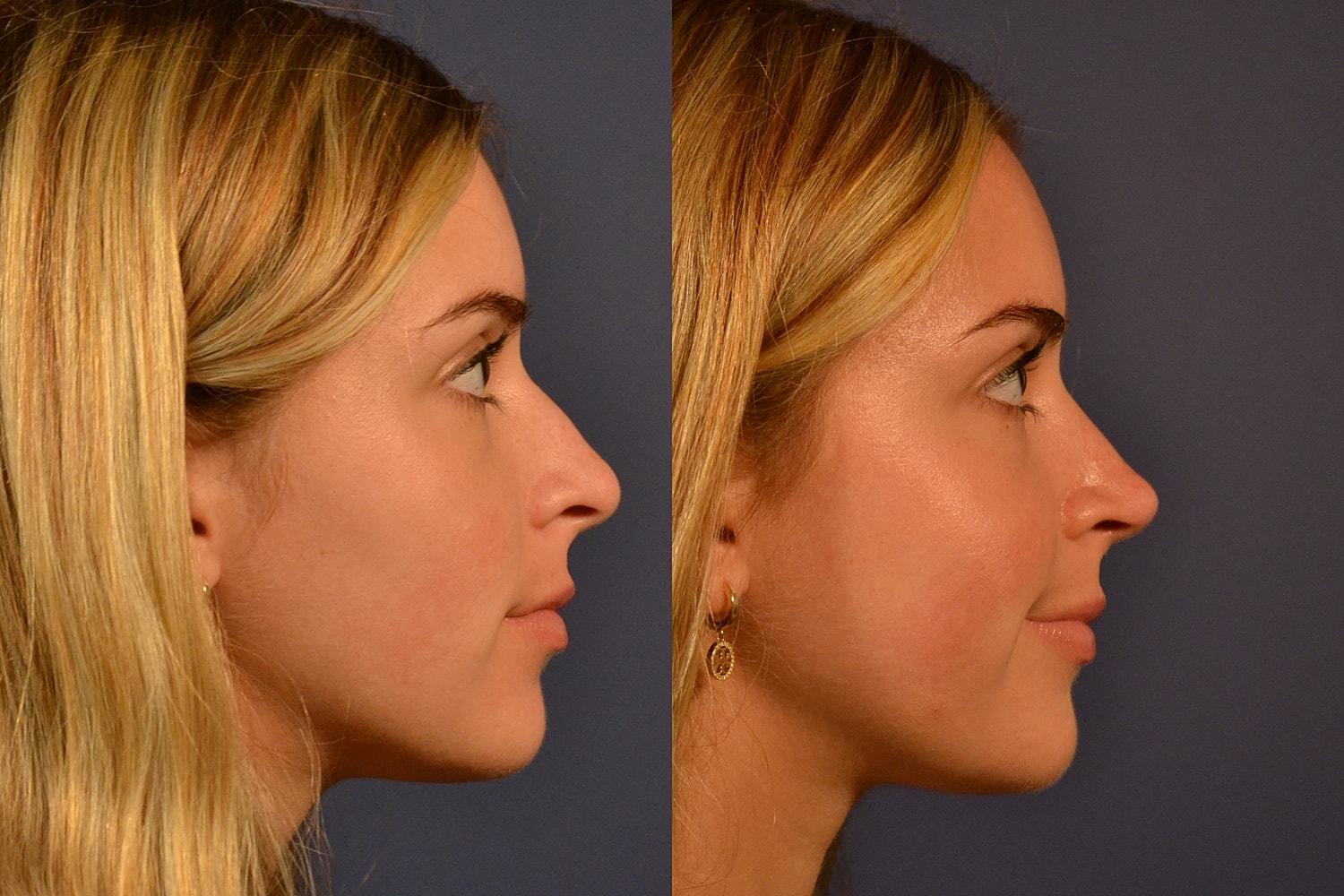 Rhinoplasty Before & After