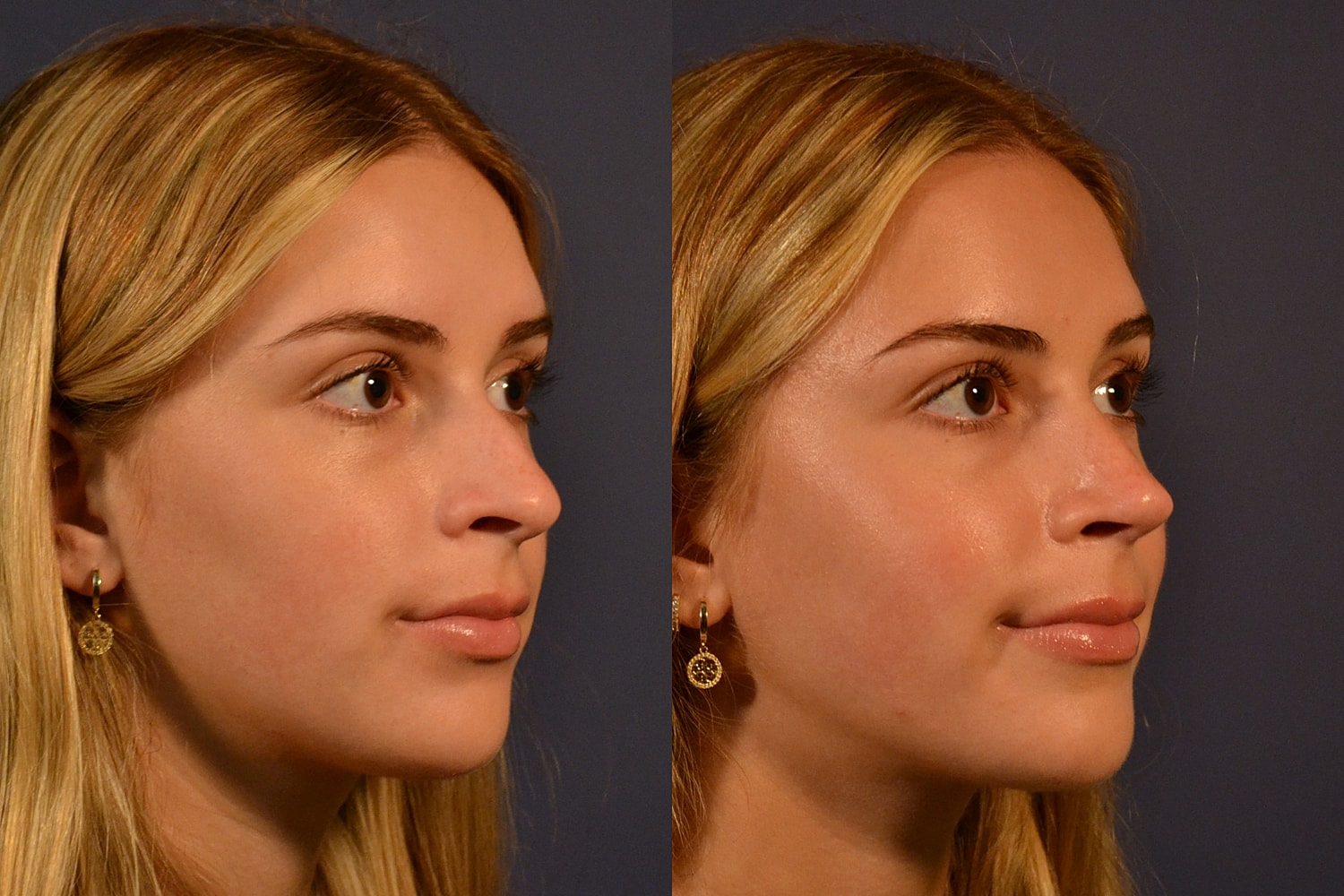 Rhinoplasty Before & After