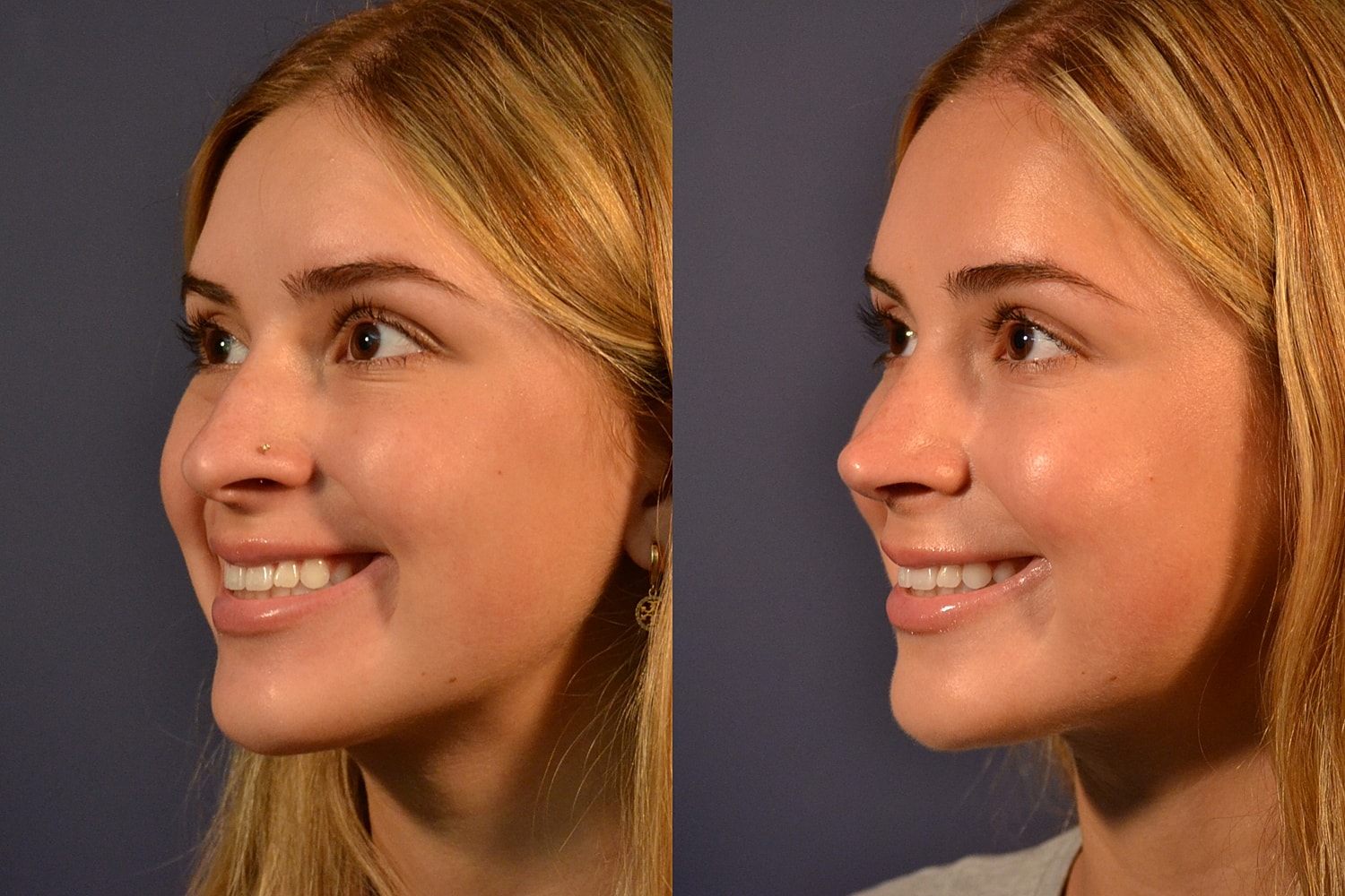 Rhinoplasty Before & After