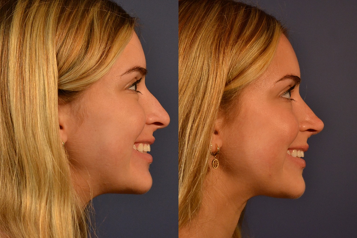 Rhinoplasty Before & After