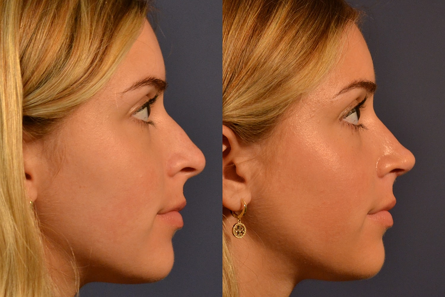 Side profiles comparison of a woman's face.