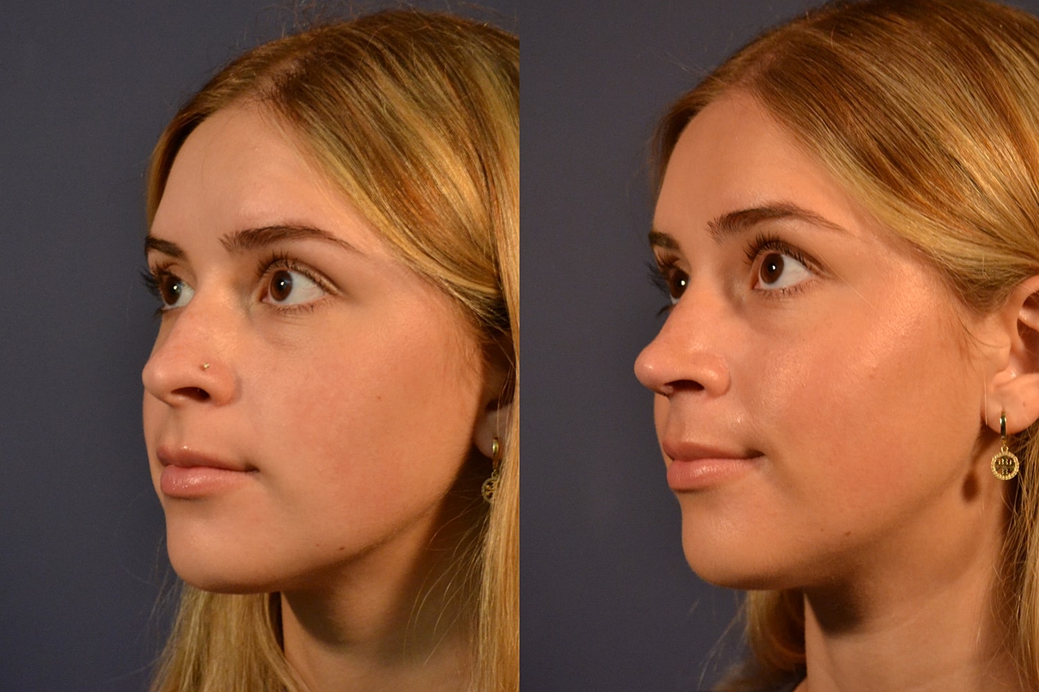 Side profile comparison of a young woman