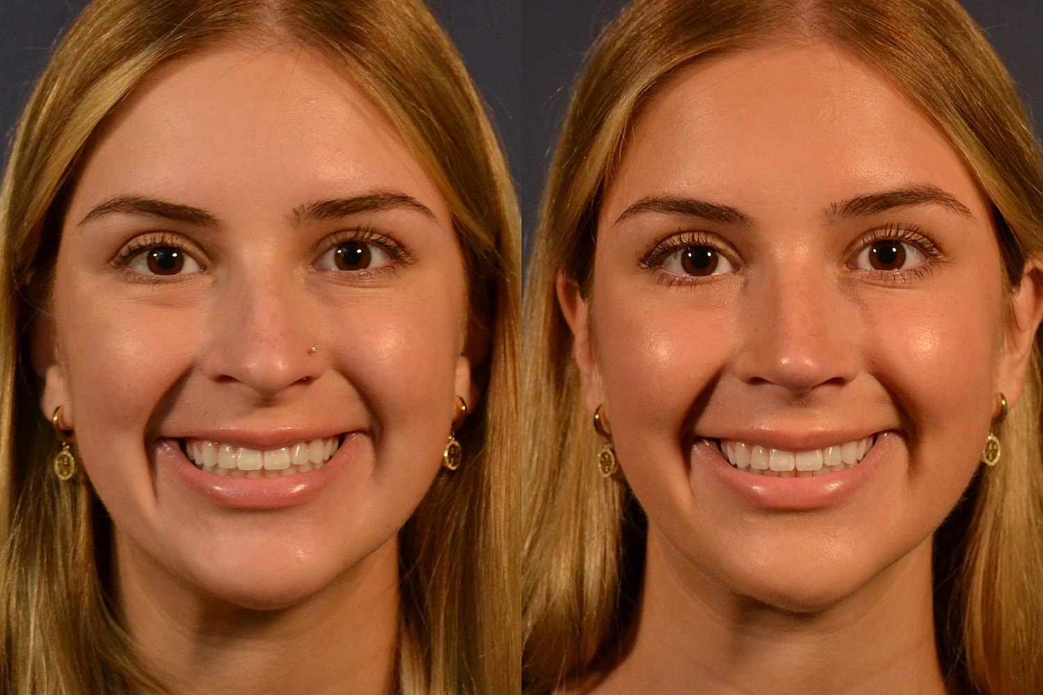 Before and after facial treatment comparison photo.