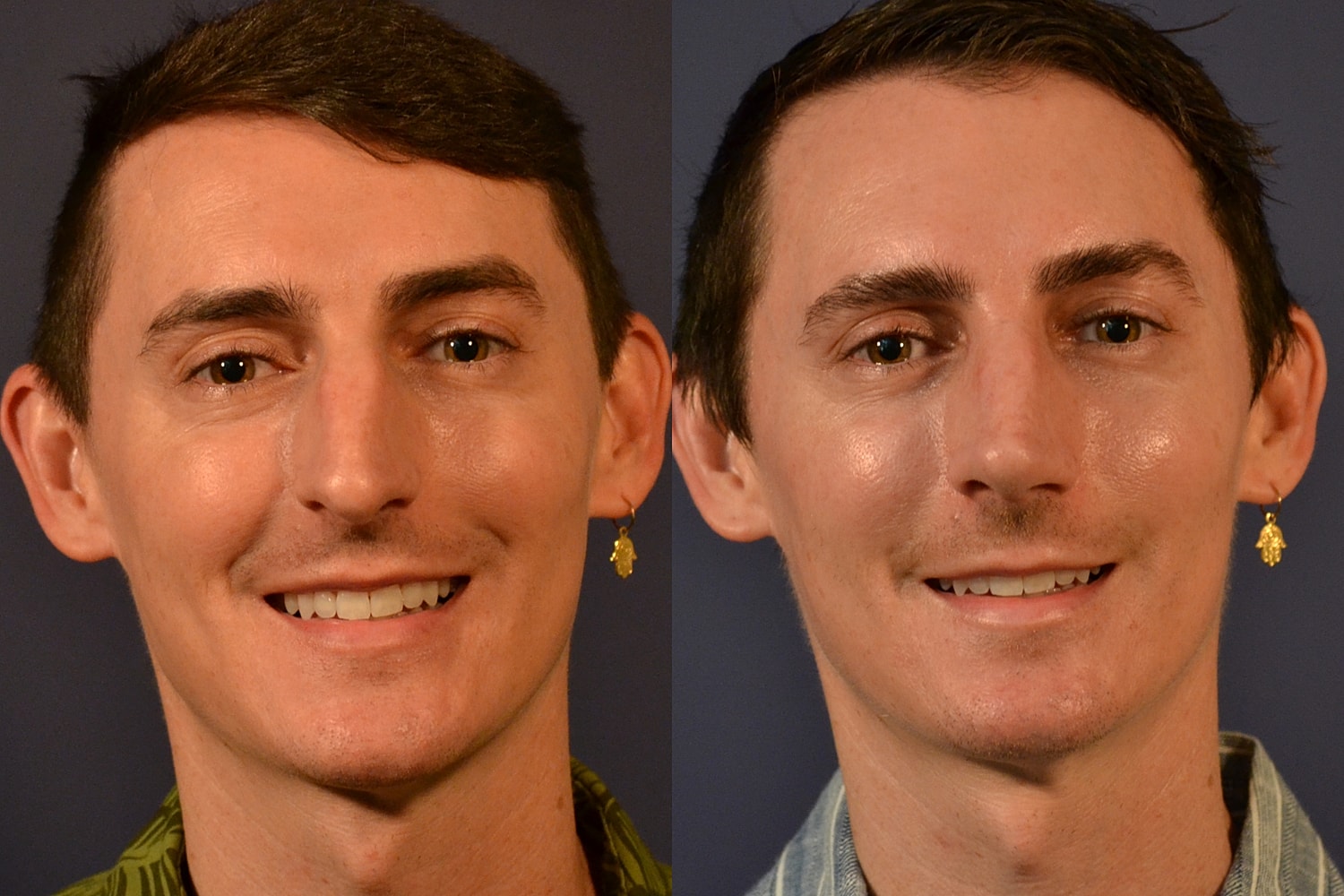 Rhinoplasty Before & After