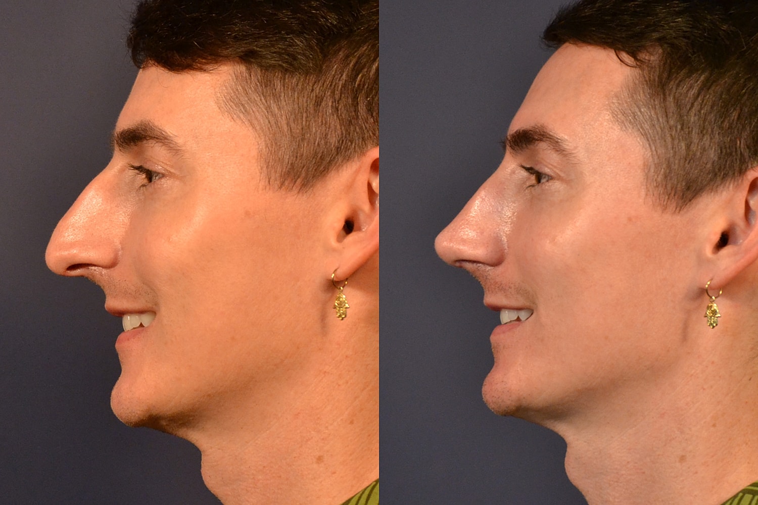 Rhinoplasty Before & After