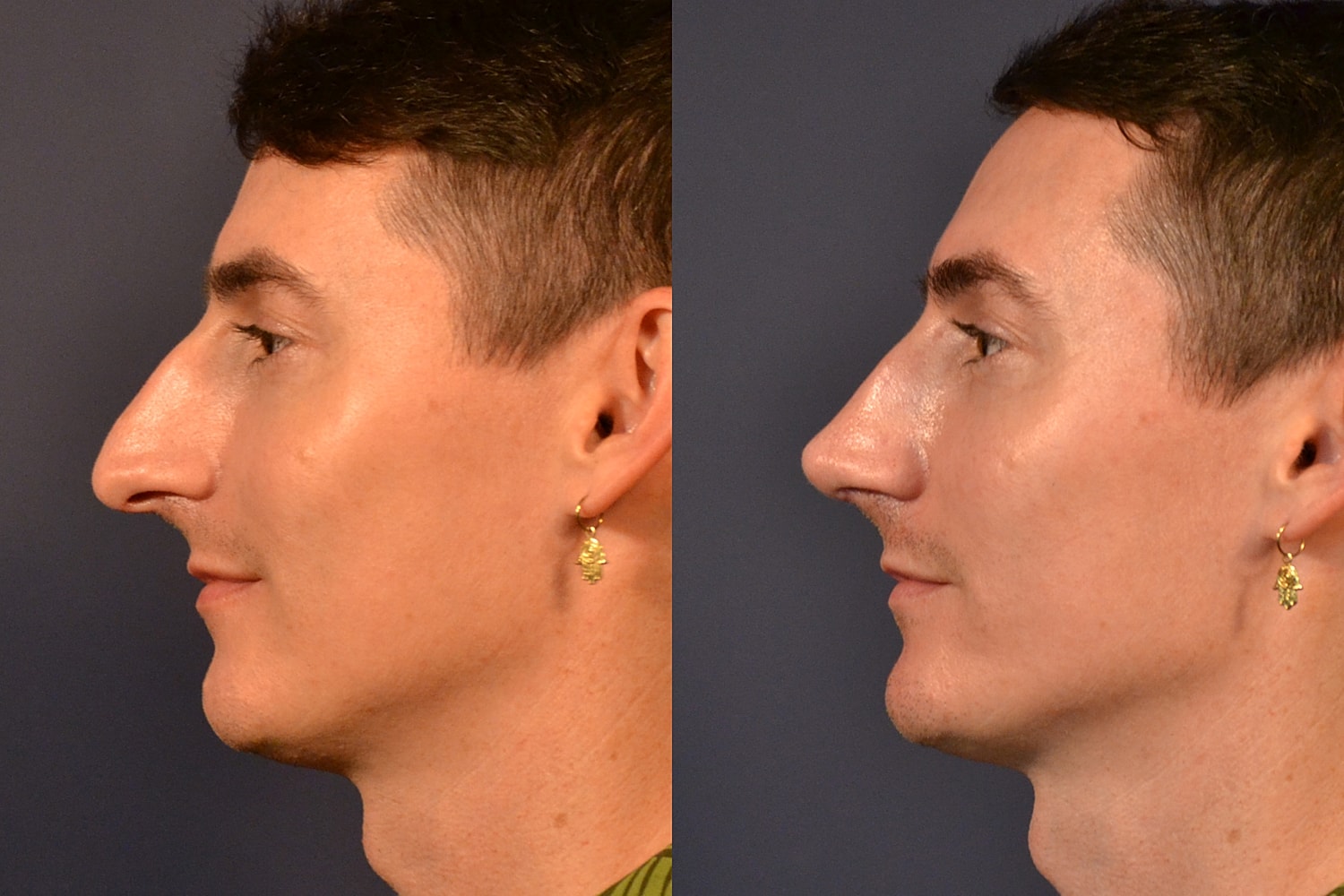 Rhinoplasty Before & After