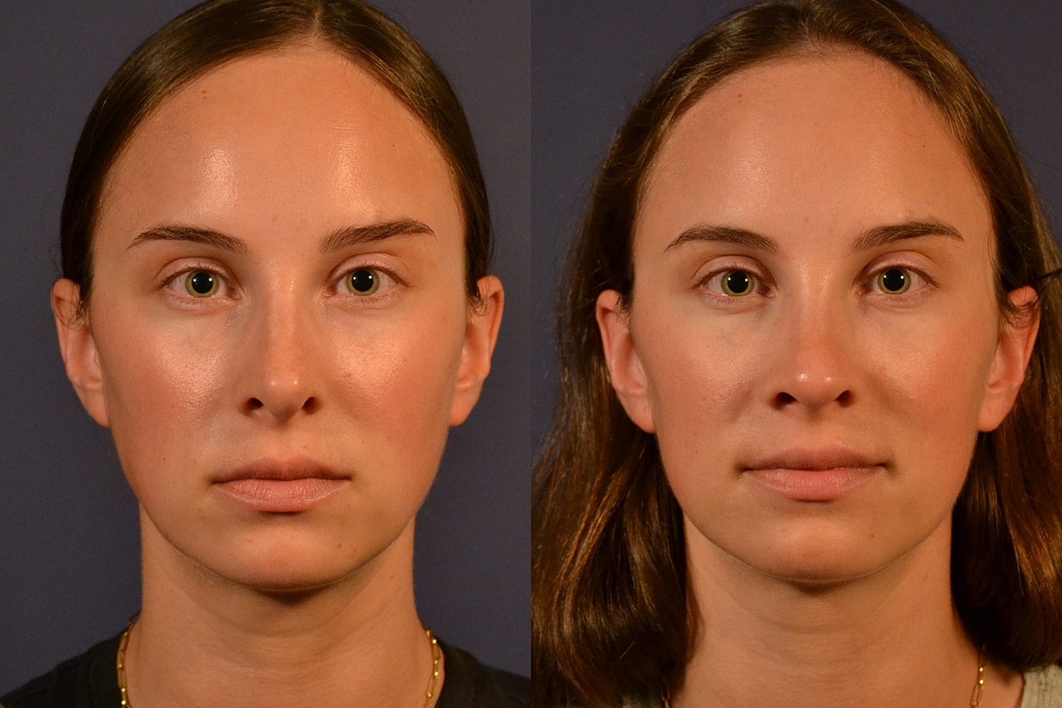 Rhinoplasty Before & After
