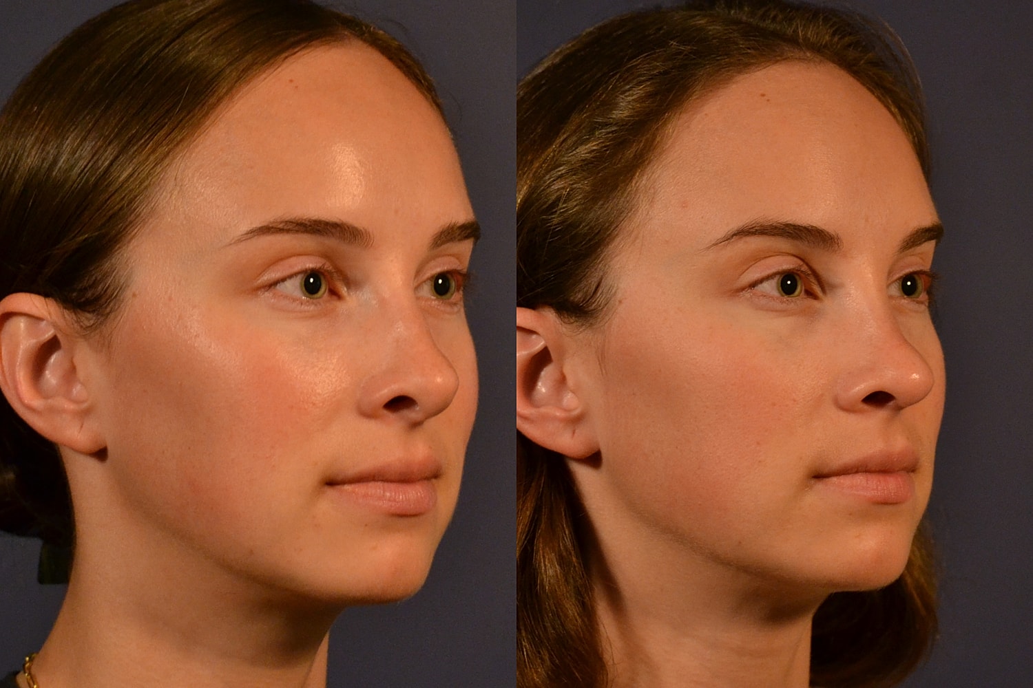 Rhinoplasty Before & After