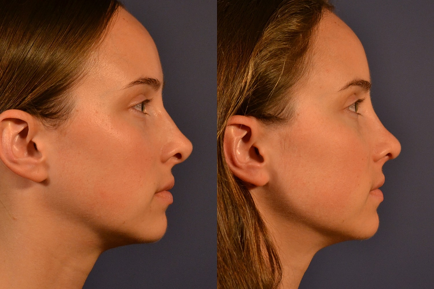 Rhinoplasty Before & After