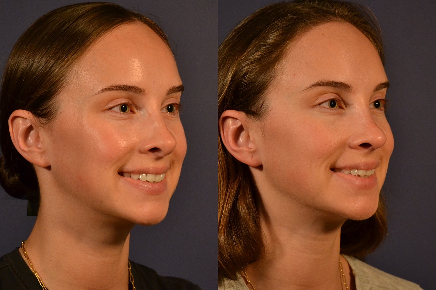 Rhinoplasty Before & After