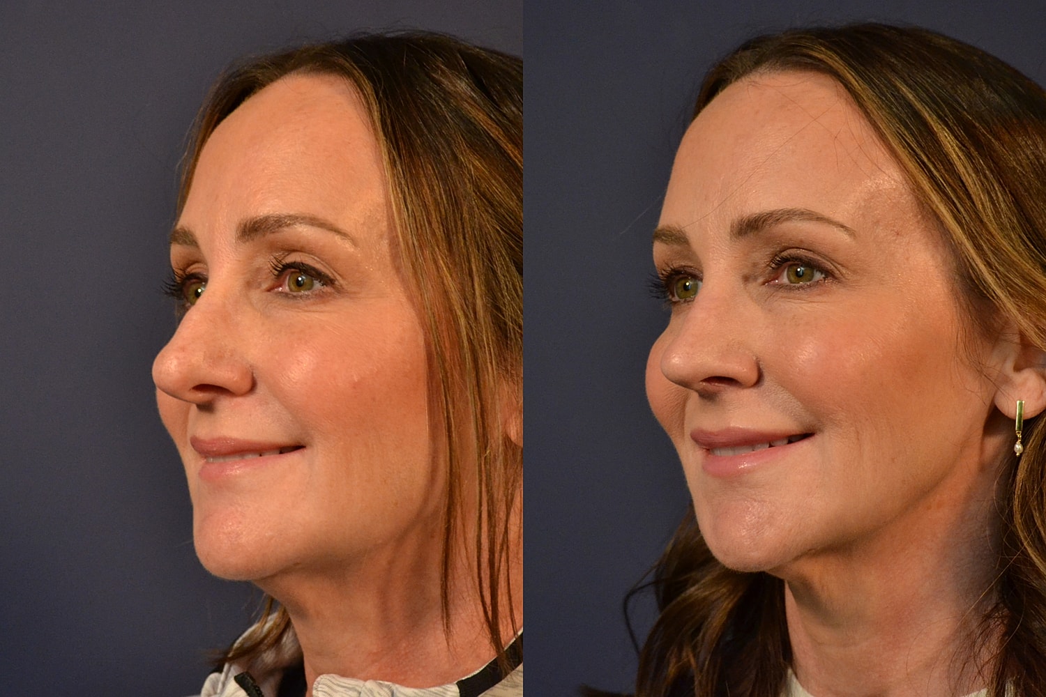 Rhinoplasty Before & After