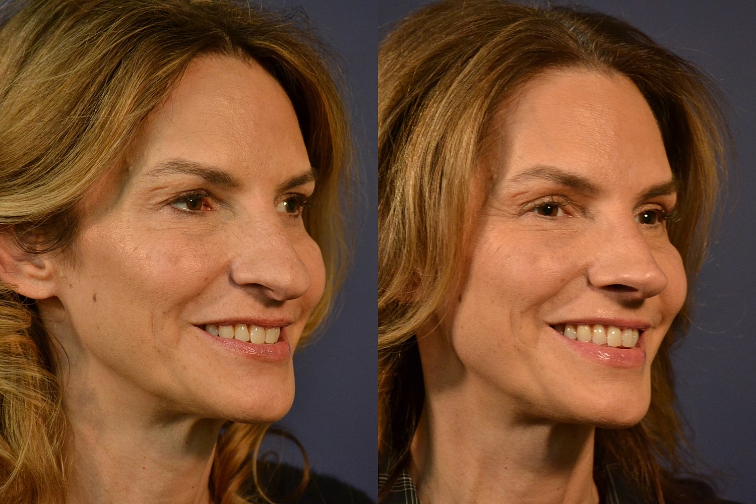 Side profile comparison of a woman's face.
