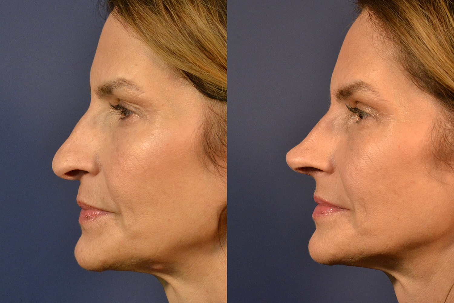 Profile comparison before and after cosmetic procedure.