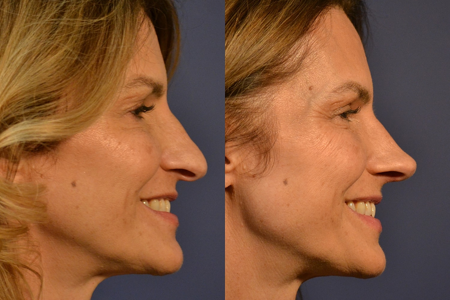 Profile comparison of woman, different expressions.