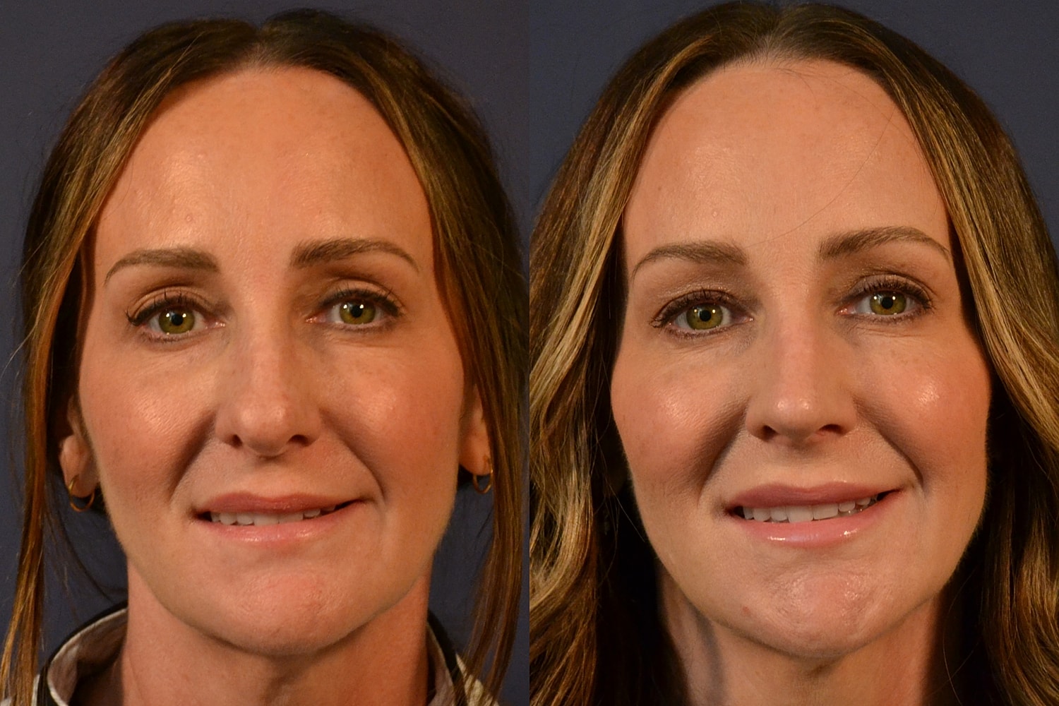 Rhinoplasty Before & After