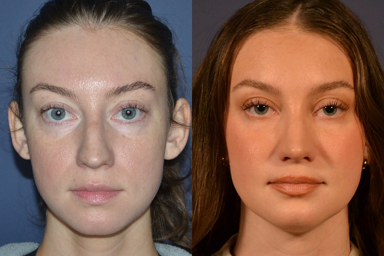 Rhinoplasty Before & After
