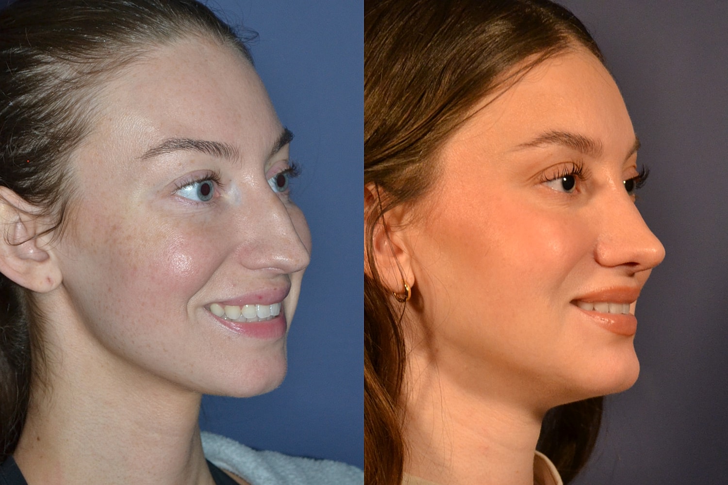 Rhinoplasty Before & After