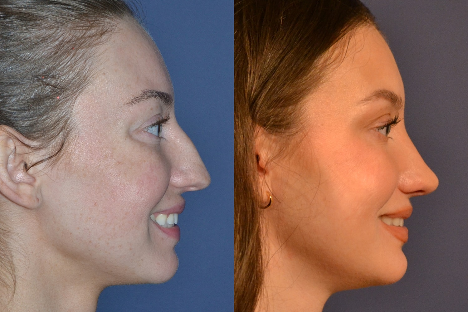 Rhinoplasty Before & After