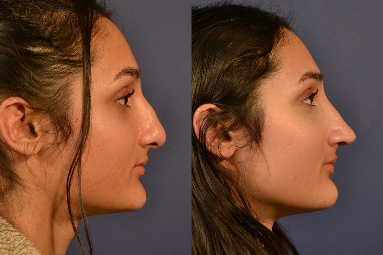Rhinoplasty Before & After