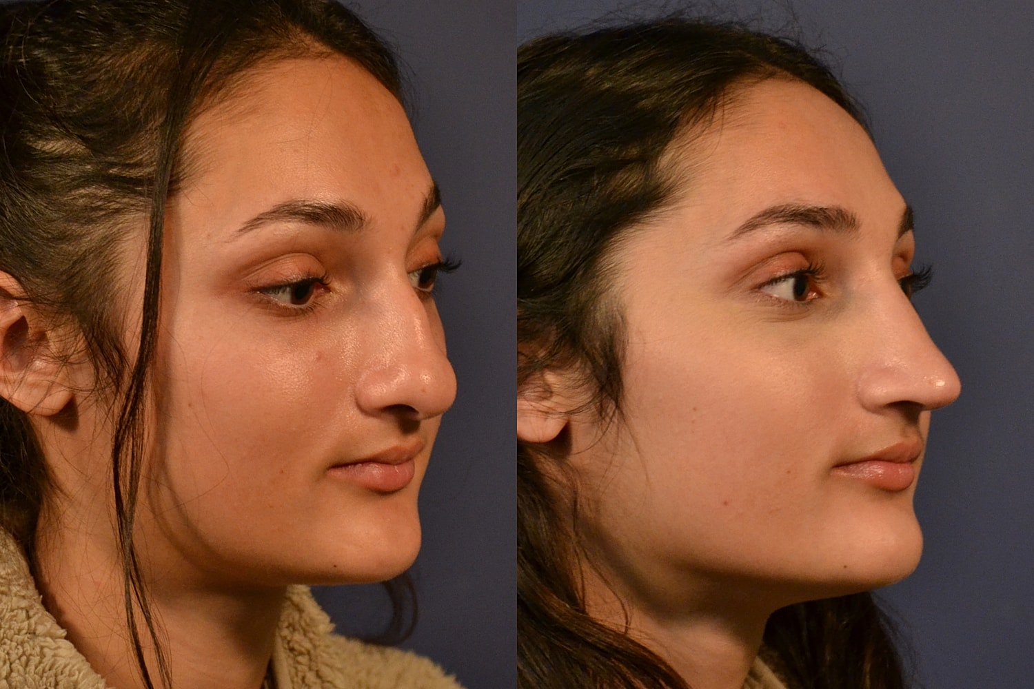 Rhinoplasty Before & After
