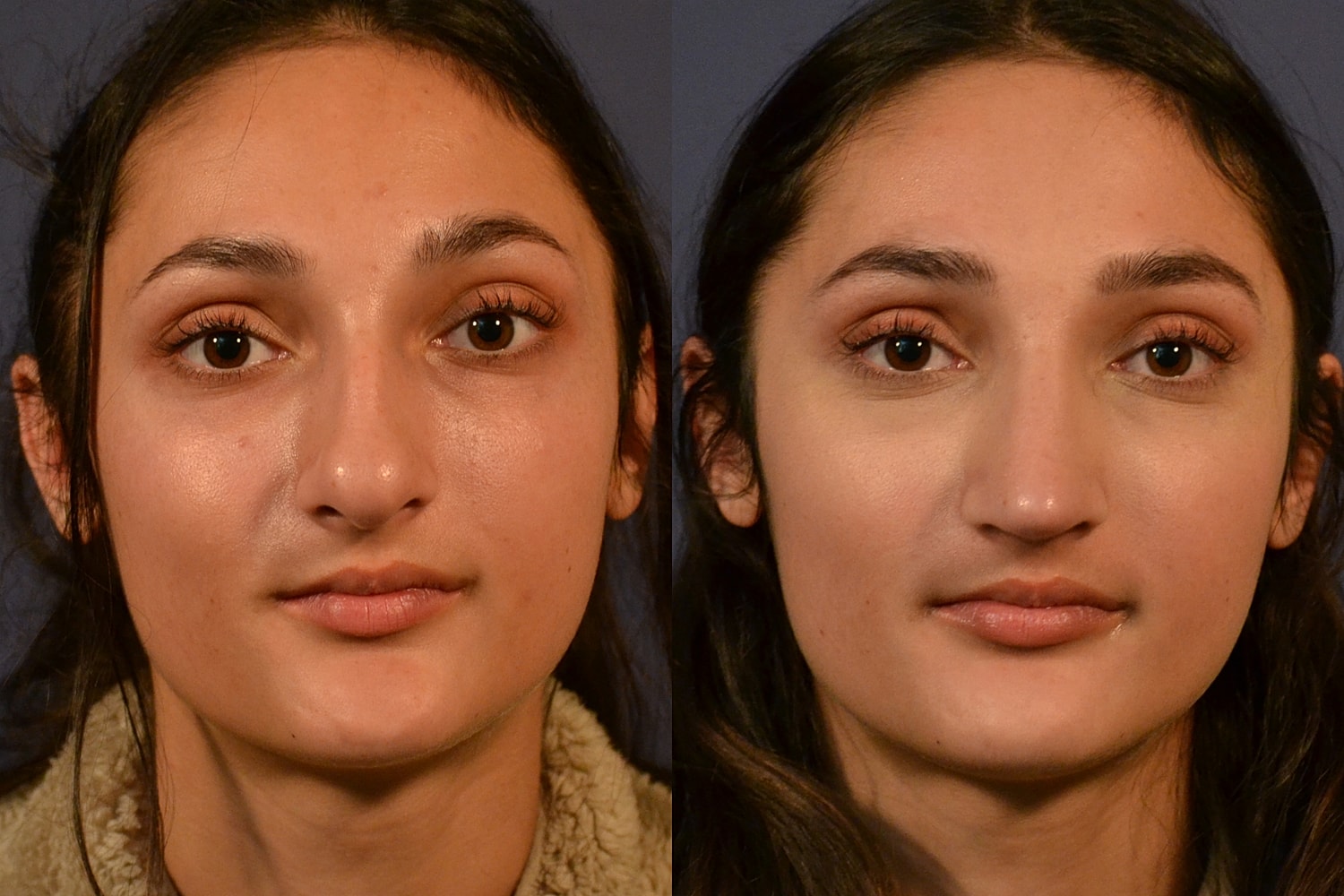 Rhinoplasty Before & After