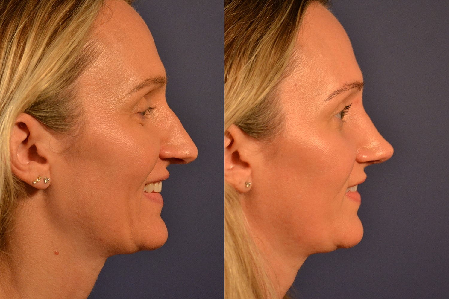Rhinoplasty Before & After