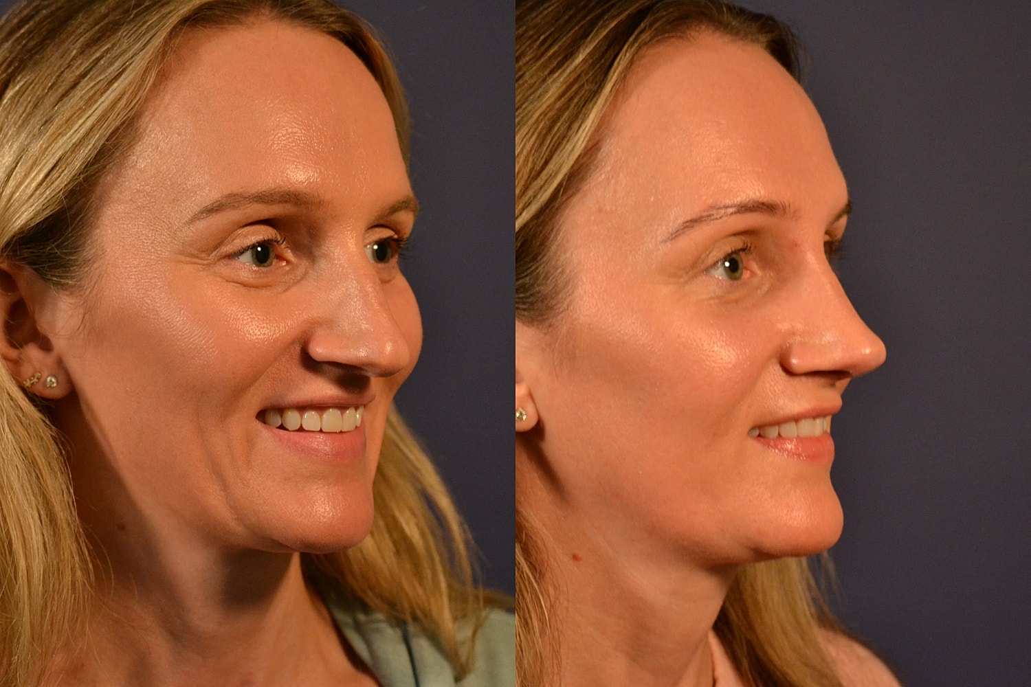 Rhinoplasty Before & After