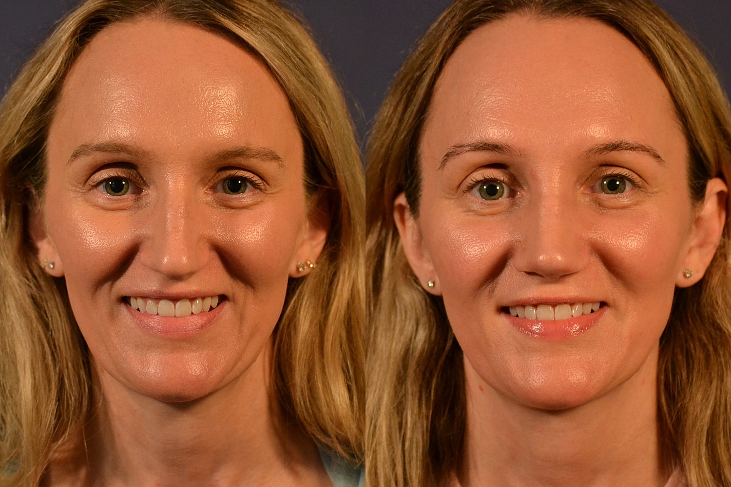 Rhinoplasty Before & After