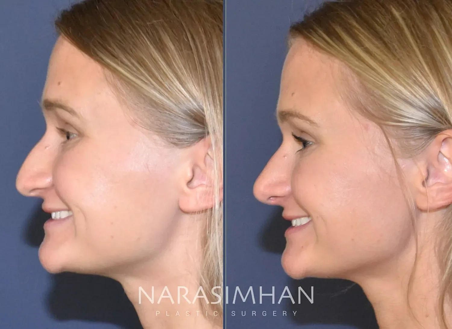 Rhinoplasty Before & After