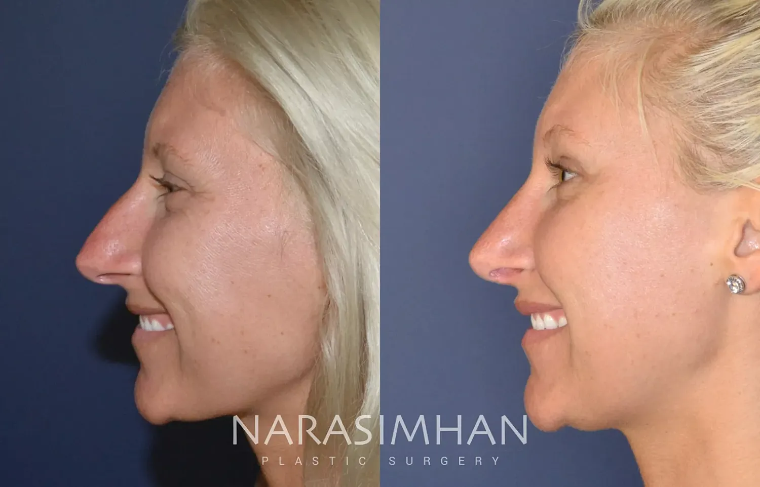 Rhinoplasty Before & After