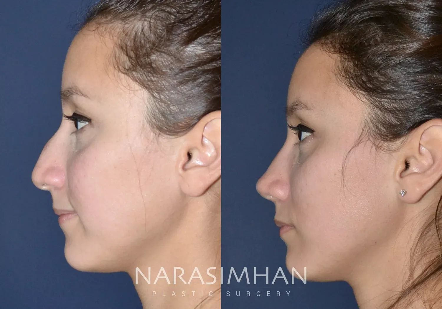 Rhinoplasty Before & After